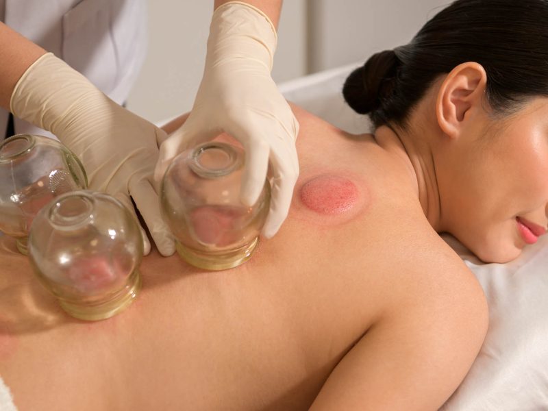 Zhi Cheng Praktijk Rotterdam Cupping